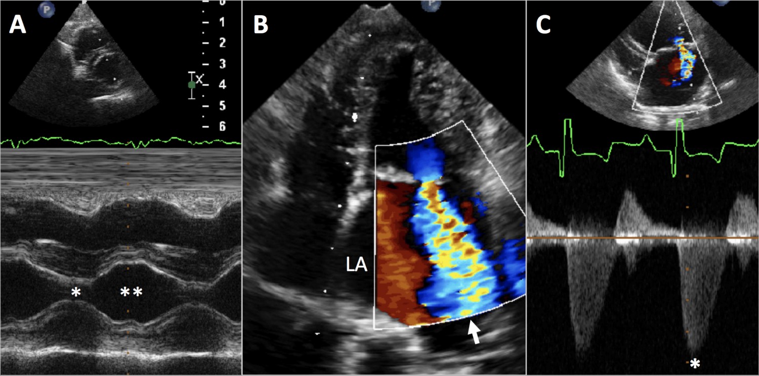 Echocardiogram